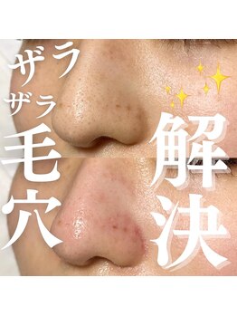 エトレ(ETOLE)/毛穴洗浄　鼻のみ