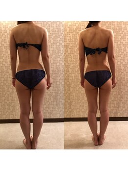 アトリス(Atriz)/ヒップ大きさ・形を引き締め