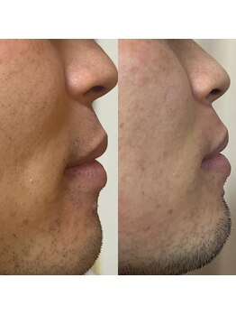 シエル 美里店(ciel)/デザインひげも脱毛出来ます♪