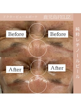 フェリス(FELIZ)/深い眉間のシワの改善に