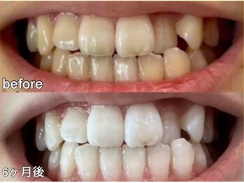 グラーティア 梅田店(gratia)/ホワイトニング★6ヶ月目★