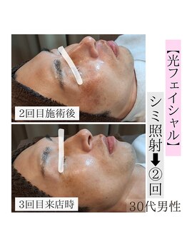 アースコアフュールボーテ ひたち野うしく店(EARTH coiffure beaute)/ダブル照射でシミケア☆光フォト