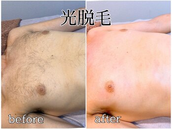 MMA/光脱毛【胸】【腹】