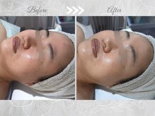 お悩みに合わせて使用する＜ピーリング商材＞で肌質改善！