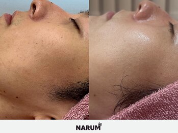 ナルムフェイシャル 代々木(NARUM facial)/白玉ピーリング