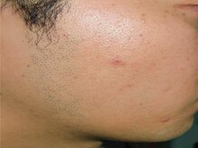 プル プリ(Puru Puri)/ヒゲ脱毛