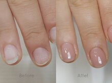 ミンスネイル(Mins Nail)/深爪矯正before&after 