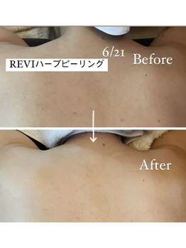 リフレ(Refre)/背中上ハーブピーリングも大人気