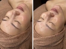 ラヴィオス(RAVIOS)/ハーブピーリング/ララピール