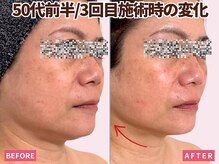 ベモーレ 谷町九丁目 上本町/50代プラズマ×幹細胞3回☆