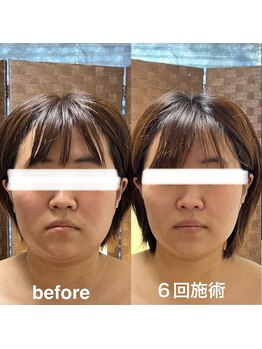 ソラ(sola*)/小顔コルギ90分 6回施術