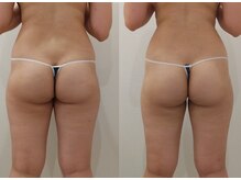 クレール アオヤマ(CLAIRE AOYAMA)/ヒップ・太ももボリュームダウン