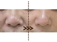 リエイト(Re:eight)/ハイドラ毛穴洗浄