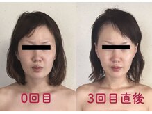 エヌ アンド エイチ ソニックフィット(N&H sonicfit)の雰囲気（ソニックフィットの3回目の効果。エイジングケアにはおすすめ！）