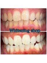 ホワイトニングショップ 豊川店/Before After豊川ホワイトニング