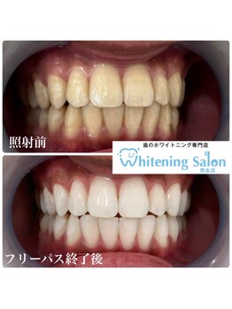 ホワイトニングサロン 熊本店/【ホワイトニング施術例】