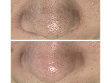 ルナート(Lunart)/毛穴洗浄／毛穴ケア