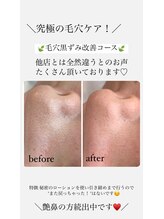 リーミー(Re:me)/★毛穴改善コース★before/after