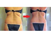 痩身 セル脂肪専門 スタイルデザイン/背中のハミ肉スパッ★と落します