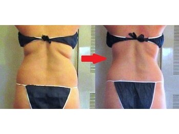 痩身 セル脂肪専門 スタイルデザイン/背中のハミ肉スパッ★と落します