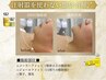 【顔のお肉スッキリ！】平日限定◎ 脂肪分解レモンボトルで脱二重アゴ！2cc　