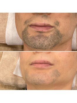 テトテ(tetote)/ヒゲ脱毛