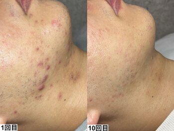 アンドミー 福岡博多店(&me)/ハーブピーリング【ニキビケア】