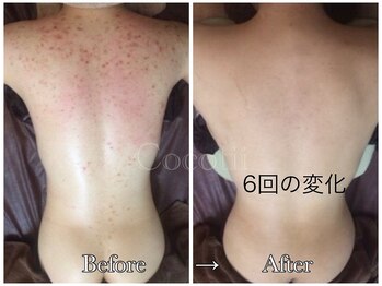 ココティー 大阪店(Cocotii)/背中 6回のケアの変化です