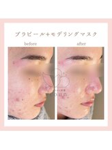 韓国肌管理yeoun【ヨウン】ROMAPINK/黒ずみ/毛穴/プラピール/ララピール福岡天神/プラピール/プラピール福岡