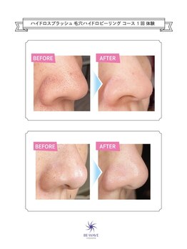 スワロー(Swallow)/ハイドロスプラッシュ鼻の黒ずみ