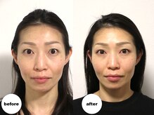 グランルーツ(GranRoots)/小顔矯正before/after