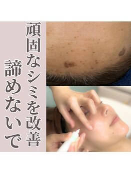 エステティック エイチアンドビー 大和店(H&B)/シミケア　フェイシャル