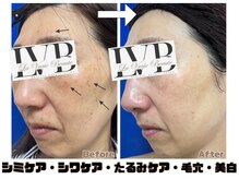 ラヴレボーテ(La Vraie Beaute)/肌改善途中経過