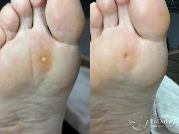 ポドロ(PoDoLo)の写真/専用の機械で時短＆痛みを最小限に。角質・魚の目をケアし、肩こりや腰痛の改善にも効果的