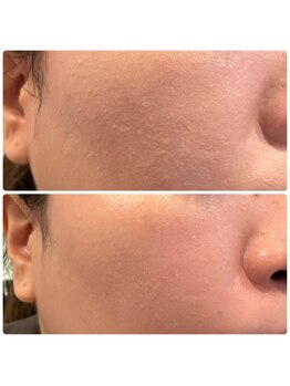 ジョルジオ東京/カーボンピーリング