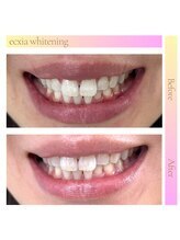 エクシアホワイトニング 西宮北口店/ホワイトニングビフォーアフター