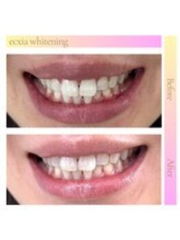 エクシアホワイトニング 西宮北口店/ホワイトニングビフォーアフター