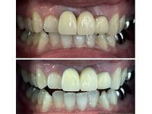 ホワイトニング美白ラボ 筑西店(ホワイトニング美白LAB)/