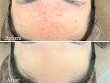 ニキビ研究所 町田店/おでこニキビケア