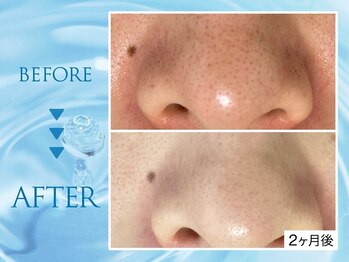 クリアラボ 池袋2nd(Clear Lab)の写真/【韓国式肌管理専門店】[韓国式毛穴洗浄¥4000～]小鼻黒ずみ・皮脂詰まりを集中ケア！[メンズ/毛穴/池袋]