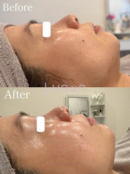 ルノン(Lunon)/毛穴洗浄ハイドロ×ララピール