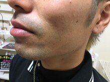 プル プリ(Puru Puri)/ひげのコンプレックス解消！