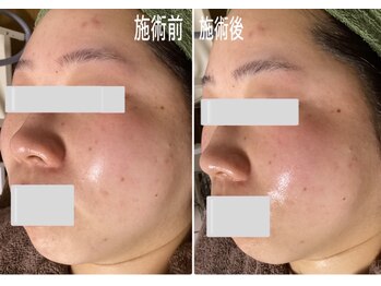 ブライトリー(Brightly)/1回でこの変化です!