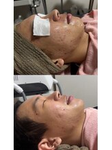 ティグレ 岡山店(TIGRE)/光フェイシャル（ニキビ予防）