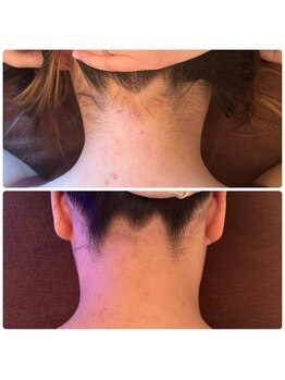 ジョルジオ東京/LED脱毛