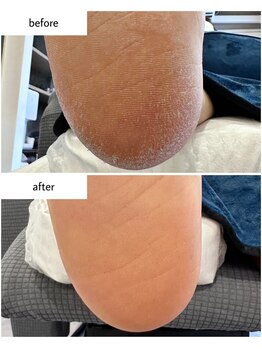 ケアプラス(care plus)/足裏角質ケア