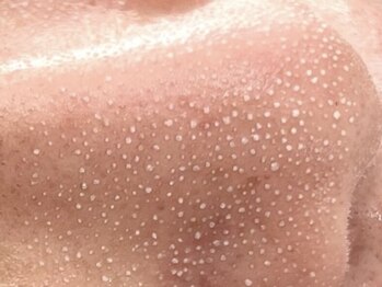 エクリュ(ecru)の写真/〈本格エステ！〉毛穴専用の美容液で毛穴詰まりを解消♪プロだからできるディープクレンジングで本気ケア！