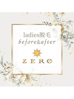 ゼロ 水戸店(ZERO)/ladies脱毛★before&after↓