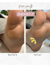 ペディラボ 荻窪店(Pedi Labo)/歩き癖でできてしまうタコ