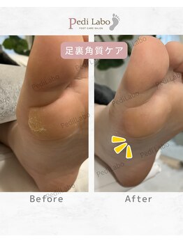 ペディラボ 荻窪店(Pedi Labo)/歩き癖でできてしまうタコ